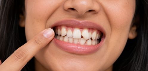 Teeth that shifted after earlier braces